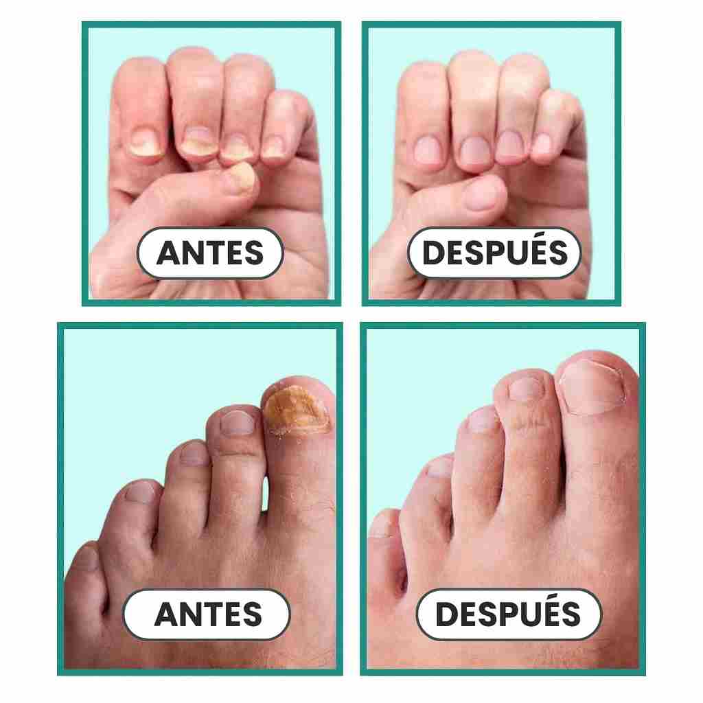 OnicoVital Láser Pro®: Renueva tus Uñas con Tecnología Láser