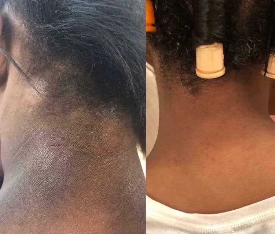 Cuello antes y después