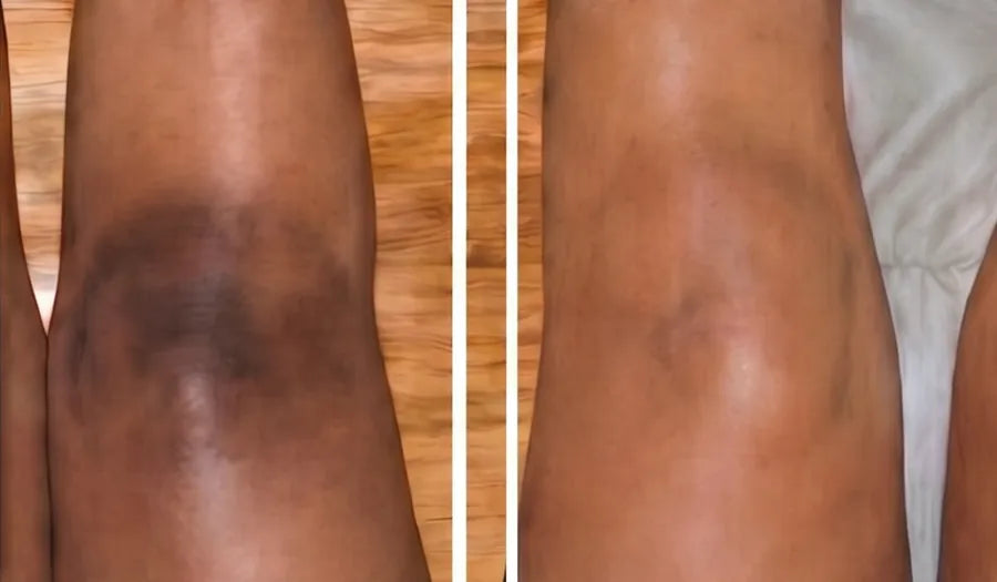 Rodilla antes y después