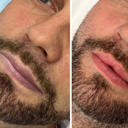 BELANI FORDYCE - LABIOS MÁS SUAVES Y RENOVADOS