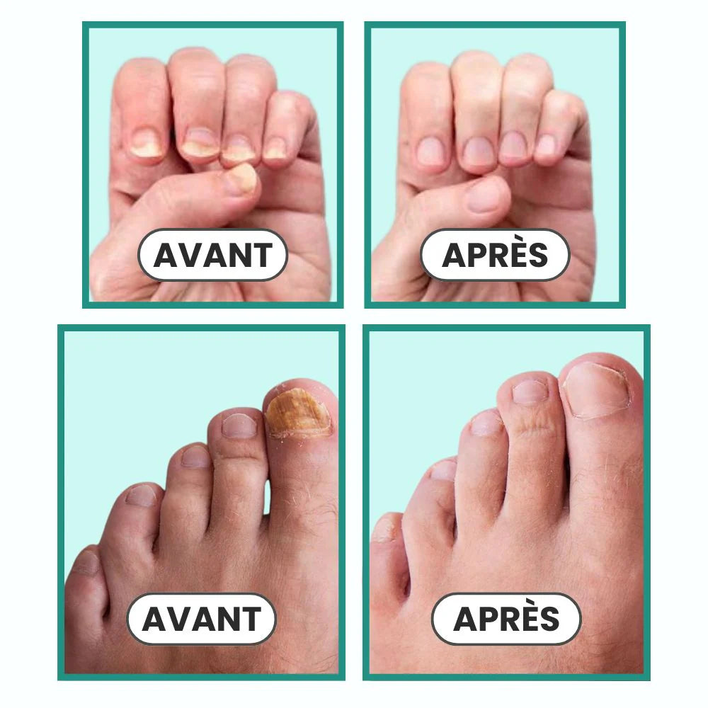 OnicoVital Láser Pro®: Renueva tus Uñas con Tecnología Láser