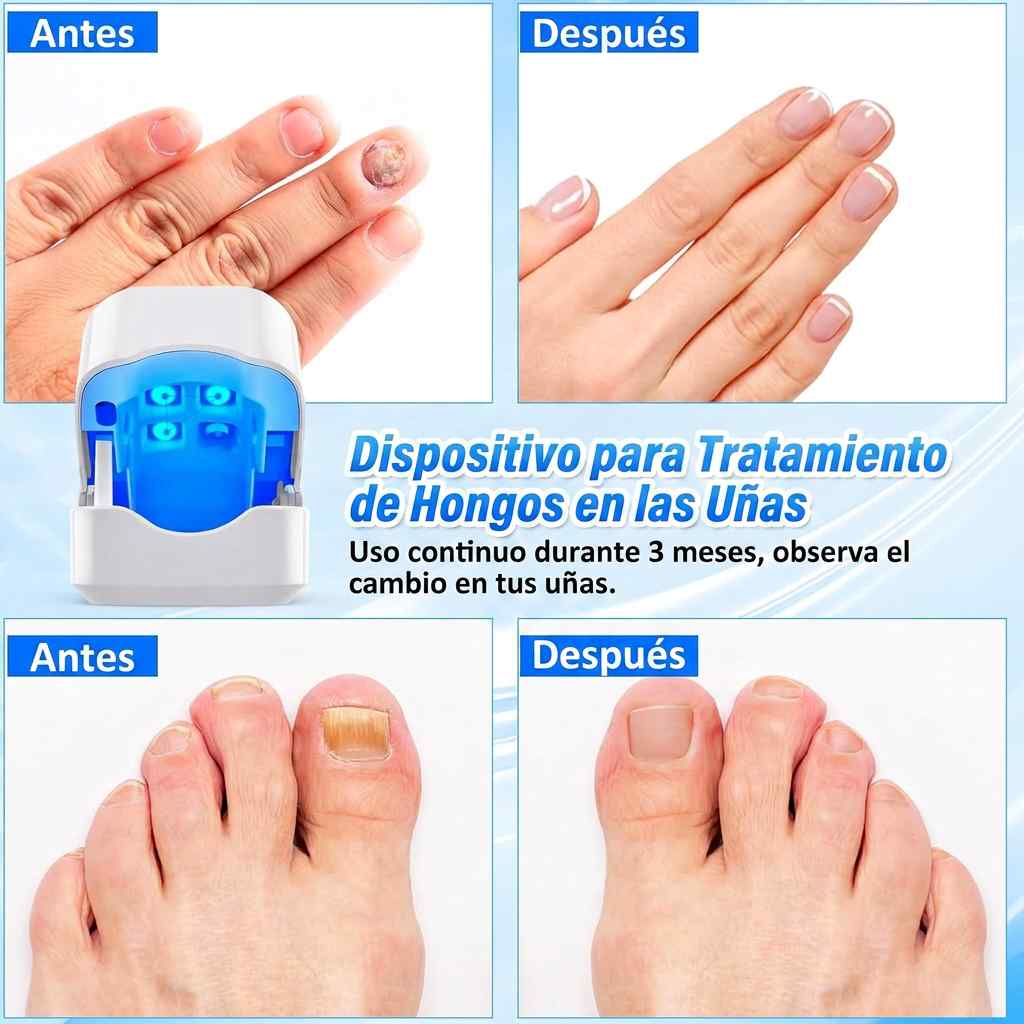 FungiClear™ - Láser Restaurador FungiClear Pro ✨